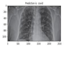 COVID-19 Detection on X-Ray Image